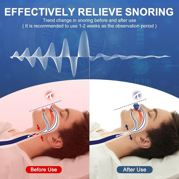 Travel-Friendly Anti-Snoring Device